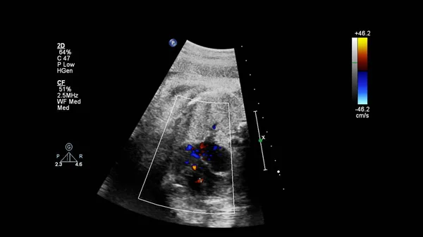 Ecrã Ultrassonográfico Com Ecocardiografia Fetal — Fotografia de Stock