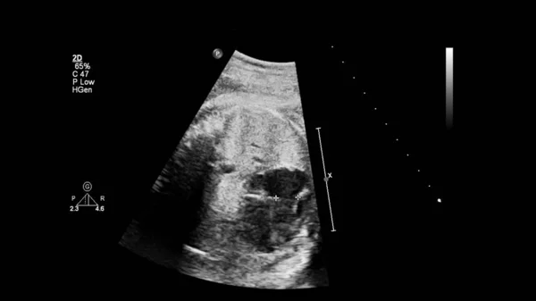 Layar Ultrasound Dengan Echocardiography Fetal — Stok Foto