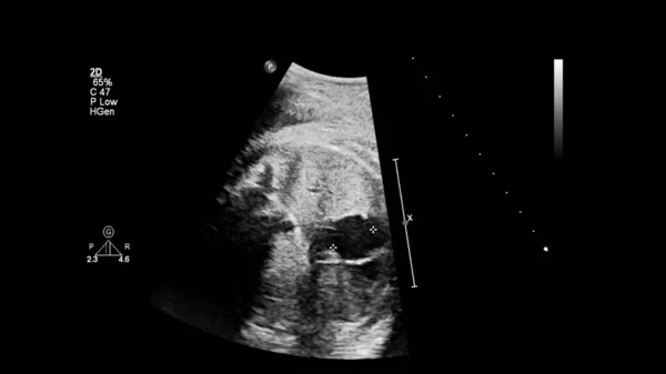 Fetal Ekokardiyografi Ile Ultrasonografi Ekranı — Stok fotoğraf