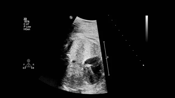 Echografie Scherm Met Foetale Echocardiografie — Stockfoto