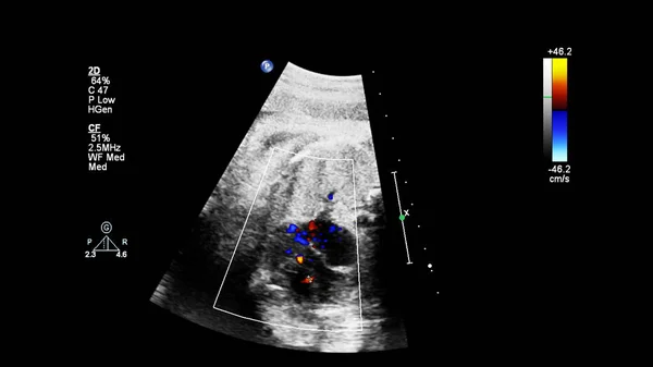 Schermo Ultrasuoni Con Ecocardiografia Fetale — Foto Stock