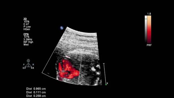 Ultrasound Screen Fetal Echocardiography — Stock Photo, Image