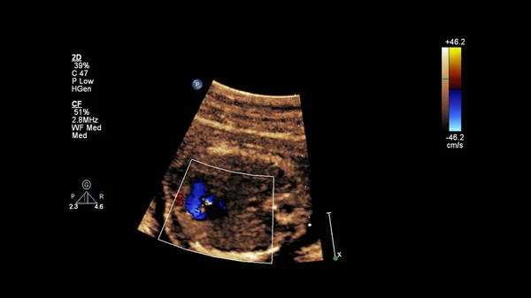 Echografie Scherm Met Foetale Echocardiografie — Stockfoto