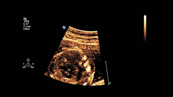 Ecrã Ultrassonográfico Com Ecocardiografia Fetal — Fotografia de Stock