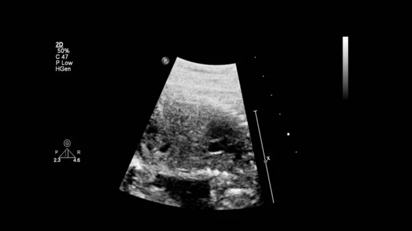 Ecrã Ultrassonográfico Com Ecocardiografia Fetal — Fotografia de Stock