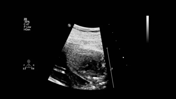 Ecrã Ultrassonográfico Com Ecocardiografia Fetal — Fotografia de Stock