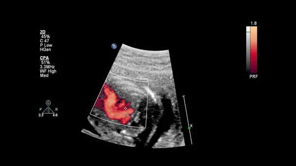 Layar Ultrasound Dengan Echocardiography Fetal — Stok Foto