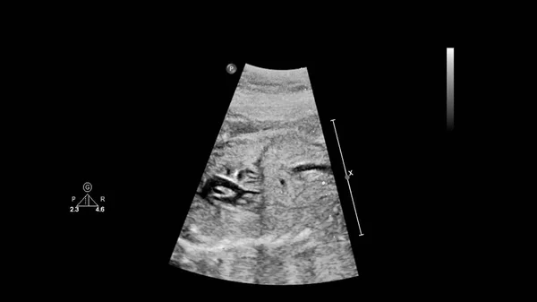 Echografie Scherm Met Foetale Echocardiografie — Stockfoto