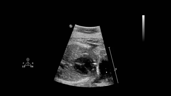 Echografie Scherm Met Foetale Echocardiografie — Stockfoto