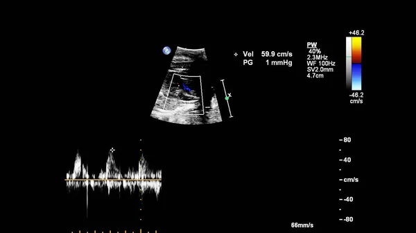 Ecrã Ultrassonográfico Com Ecocardiografia Fetal — Fotografia de Stock