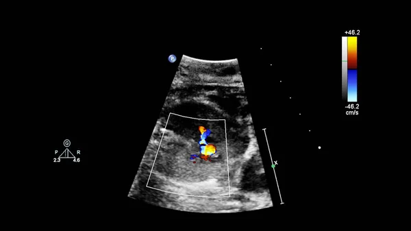 Ultrasound Screen Fetal Echocardiography — Stock Photo, Image