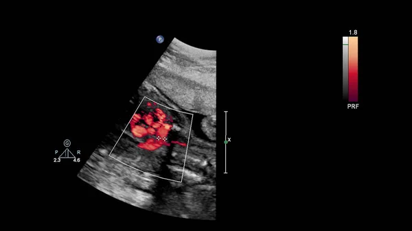 Ecrã Ultrassonográfico Com Ecocardiografia Fetal — Fotografia de Stock