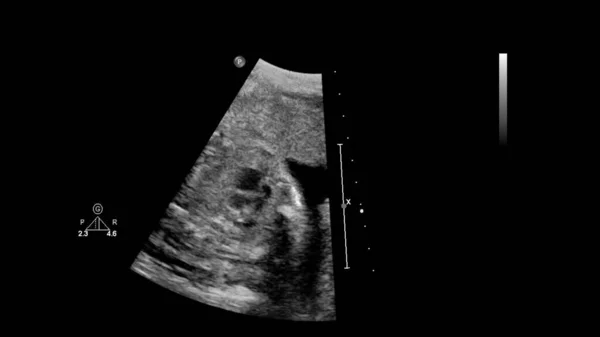 Ecrã Ultrassonográfico Com Ecocardiografia Fetal — Fotografia de Stock