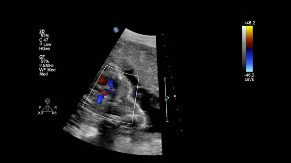 Ecrã Ultrassonográfico Com Ecocardiografia Fetal — Fotografia de Stock