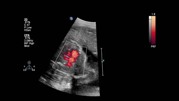 Ecrã Ultrassonográfico Com Ecocardiografia Fetal — Fotografia de Stock