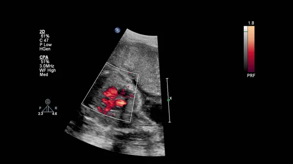 Ecrã Ultrassonográfico Com Ecocardiografia Fetal — Fotografia de Stock