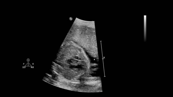 УЗИ с эхокардиографией плода
