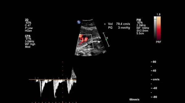Ekran Usg Echokardiografią Płodu — Zdjęcie stockowe