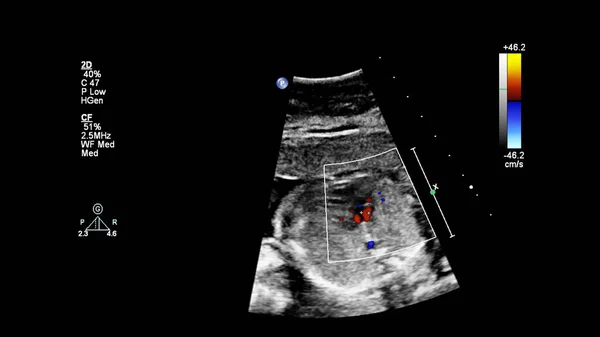 Ecrã Ultrassonográfico Com Ecocardiografia Fetal — Fotografia de Stock