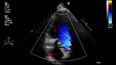 Transesophageal ultrasound video in Doppler mode.