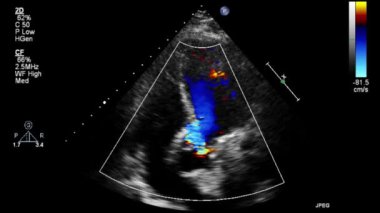 Transesophageal ultrasound video in Doppler mode.