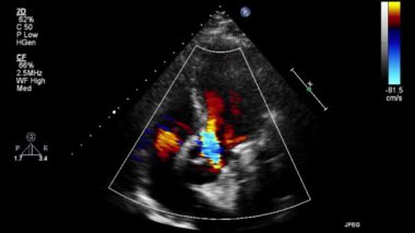 Transesophageal ultrasound video in Doppler mode.