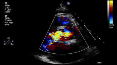 Transesophageal ultrasound video in Doppler mode.