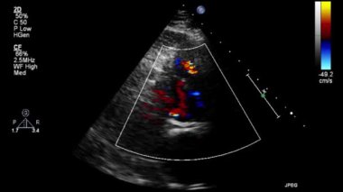 Transesophageal ultrasound video in Doppler mode.