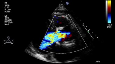 Transesophageal ultrasound video in Doppler mode.