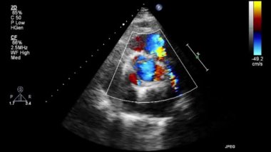 Transesophageal ultrasound video in Doppler mode.