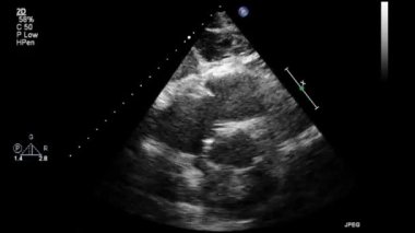 Transesophageal ultrasound video in gray-scale mode.
