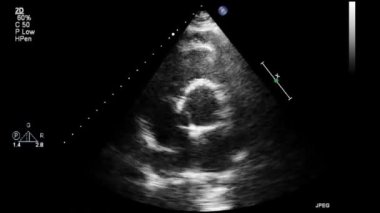 Transesophageal ultrasound video in gray-scale mode.