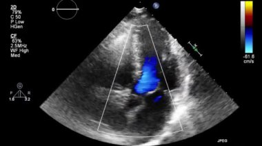 Transesophageal ultrasound video in Doppler mode.