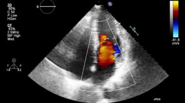 Transesophageal ultrasound video in Doppler mode.