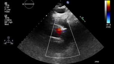 Transesophageal ultrasound video in Doppler mode.