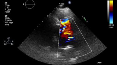 Transesophageal ultrasound video in Doppler mode.