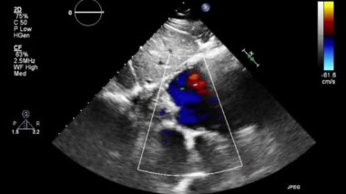 Transesophageal ultrasound video in Doppler mode.