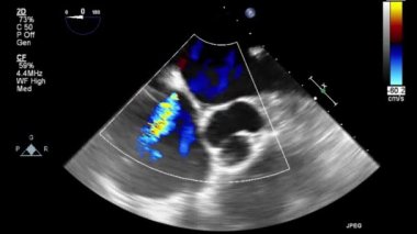 Transesophageal ultrasound video in Doppler mode.