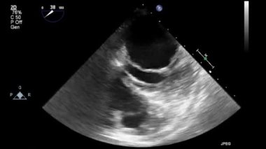 Transesophageal ultrasound video in gray-scale mode.
