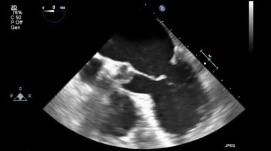 Transesophageal ultrasound video in gray-scale mode.
