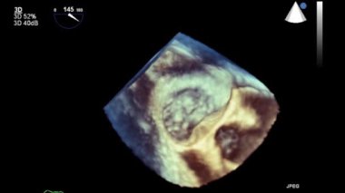Transesophageal ultrasound video in 3D mode.