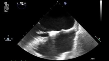 Transesophageal ultrasound video in gray-scale mode.