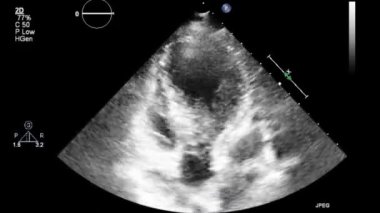 Transesophageal ultrasound video in gray-scale mode.