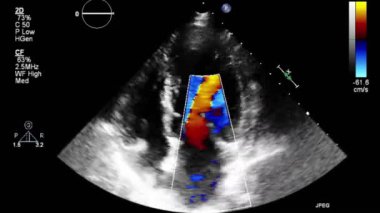 Transesophageal ultrasound video in Doppler mode.
