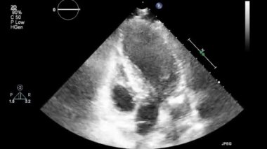 Transesophageal ultrasound video in gray-scale mode.