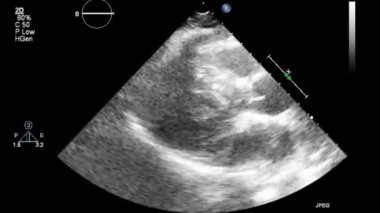Transesophageal ultrasound video in gray-scale mode.