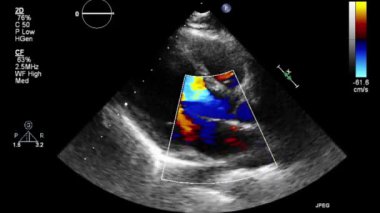 Transesophageal ultrasound video in Doppler mode.