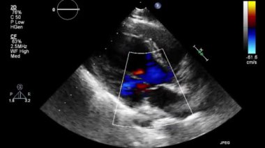 Transesophageal ultrasound video in Doppler mode.