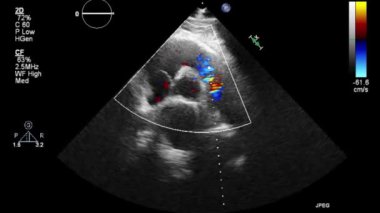 Transesophageal ultrasound video in Doppler mode.