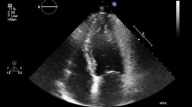 Transesophageal ultrasound video in gray-scale mode.